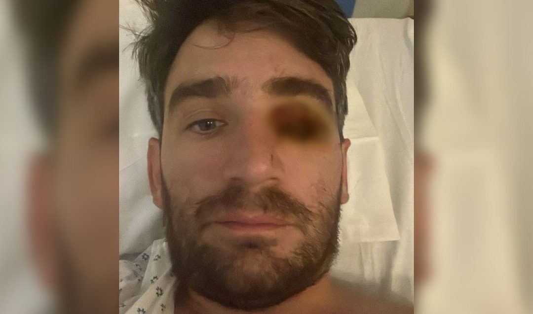 Accidente en Fiesta de Año Nuevo: Hombre Pierde un Ojo por Explosión de Fuego Pirotécnico